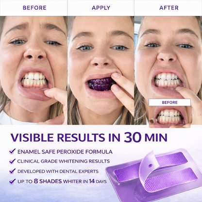 Teeth Whitening Strips: Get a Brighter, Whiter Smile in 14 Days
